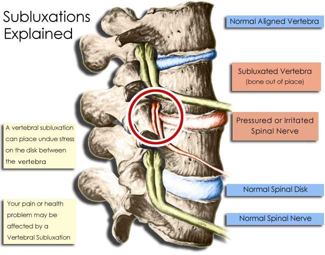 subluxations_explained